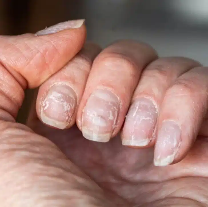 Illustration d'ongles cassants
