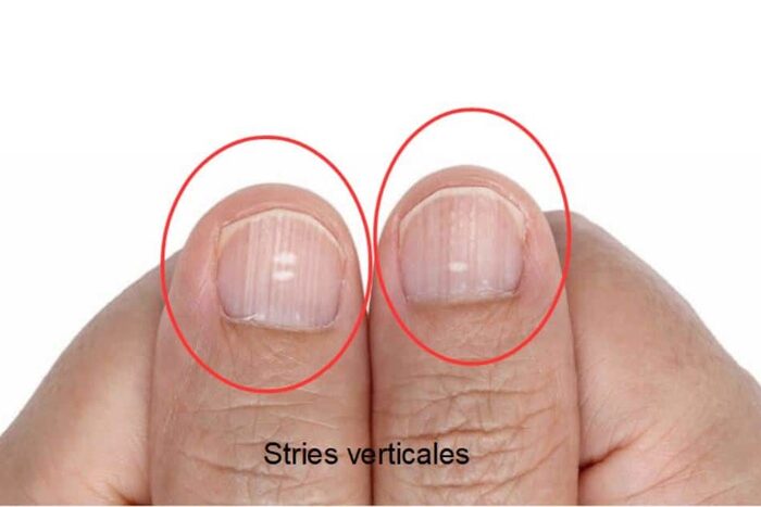 Santé : ces mystérieuses stries sur vos ongles qui en disent long sur votre corps