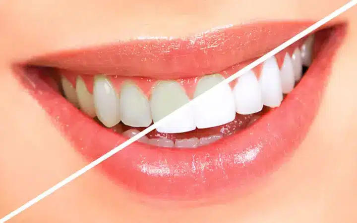 Le sourire éclatant en soixante secondes : la méthode méconnue à base de riz