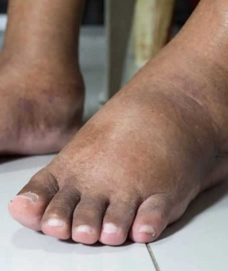 La vérité surprenante sur ce qui arrive à vos pieds quand vous portez des chaussures trop longtemps