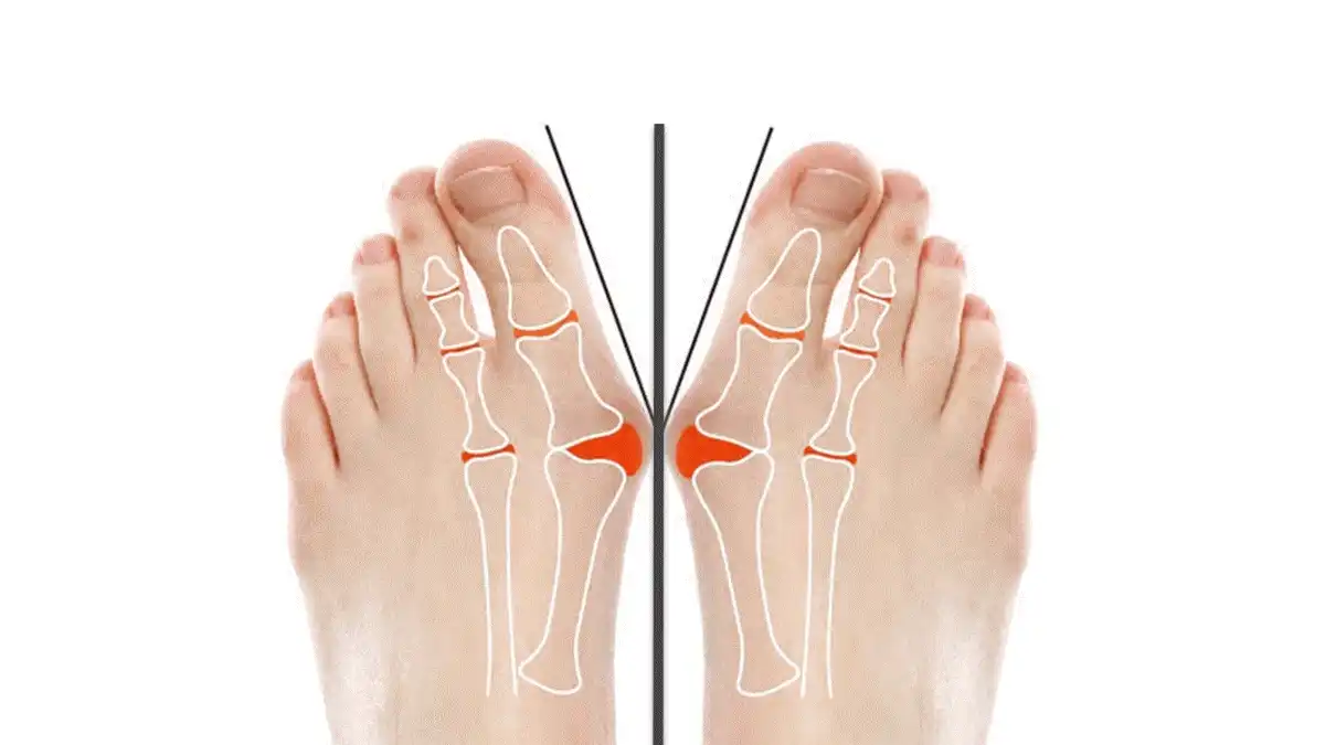 Solutions contre les oignons de pieds