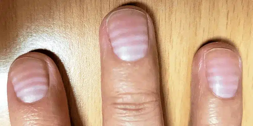 Santé : ces mystérieuses stries sur vos ongles qui en disent long sur votre corps