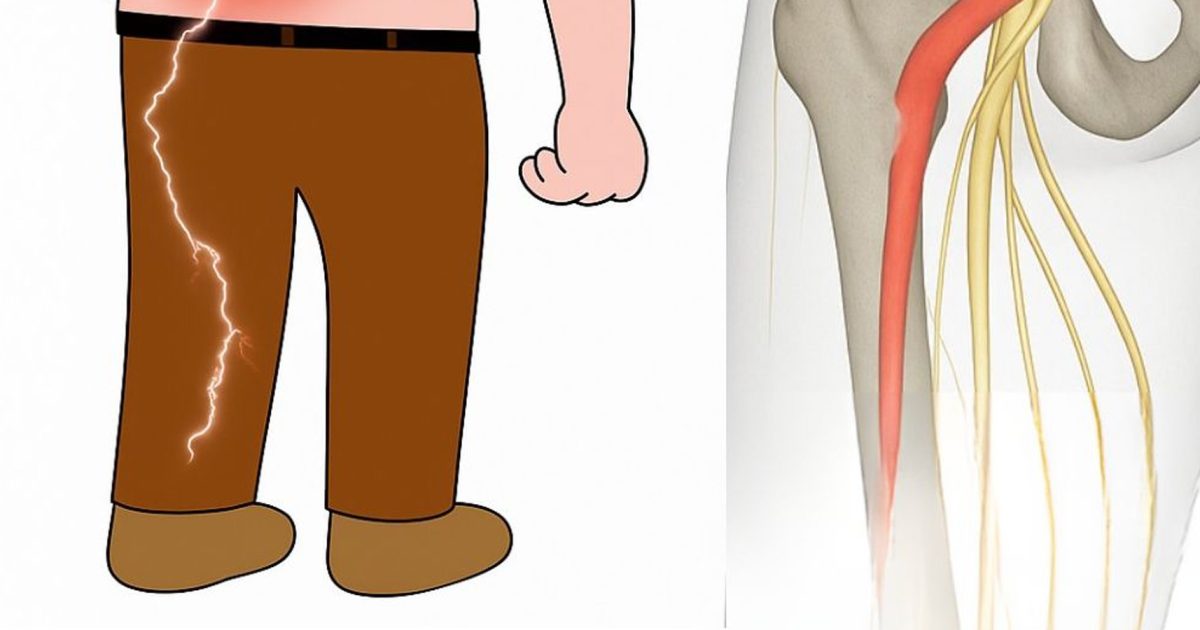 3 exercices pour soulager la douleur du nerf sciatique
