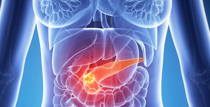 Cancer du pancréas : derrière la flambée des cas, les scientifiques explorent des pistes inattendues