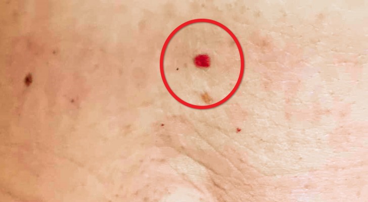 Ces petites taches rouges sur votre peau : ce qu’elles révèlent vraiment (et quand s’inquiéter)