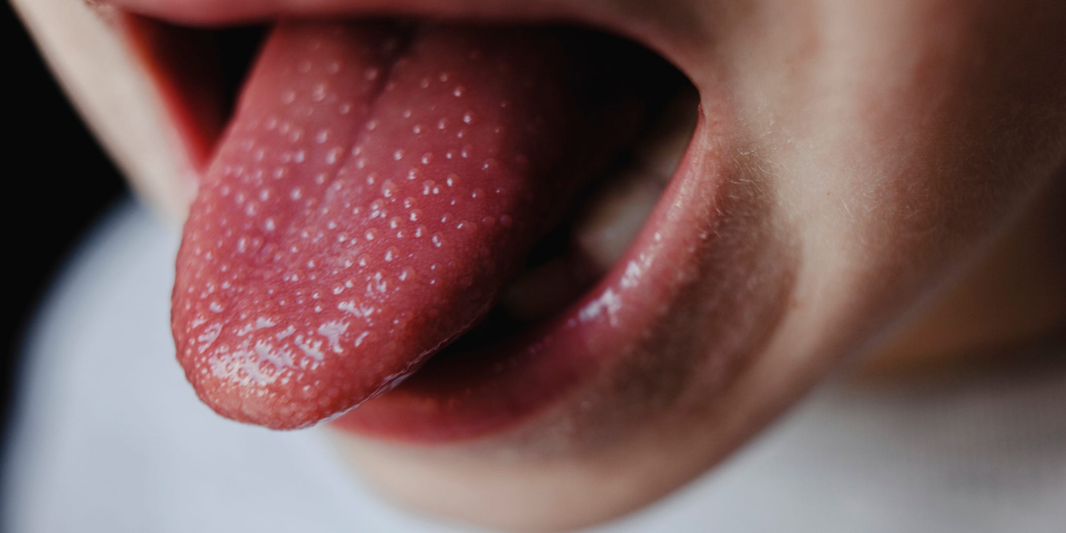 Langue avec inflammation