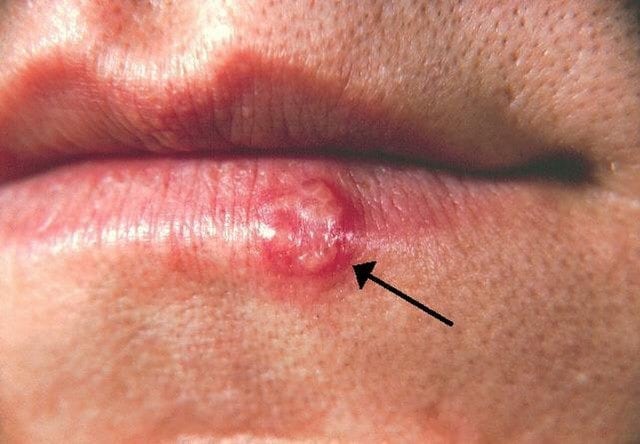 Évolution d'un bouton de fièvre