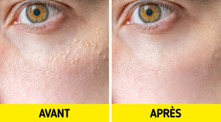 Matériel dermatologique pour extraction de milium