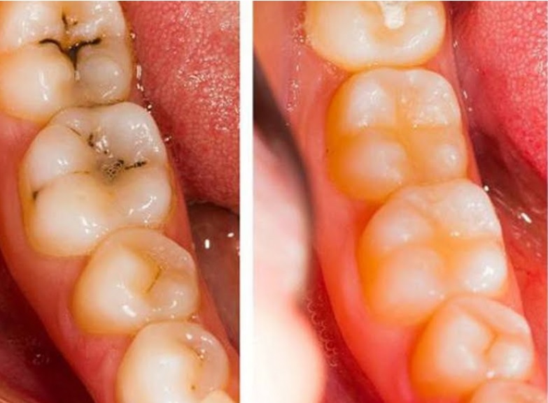 Aliments bons pour les dents