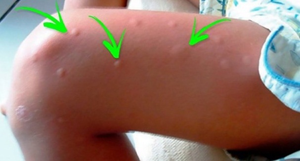 Victime préférée des moustiques ? Découvrez ce qui les attire chez vous