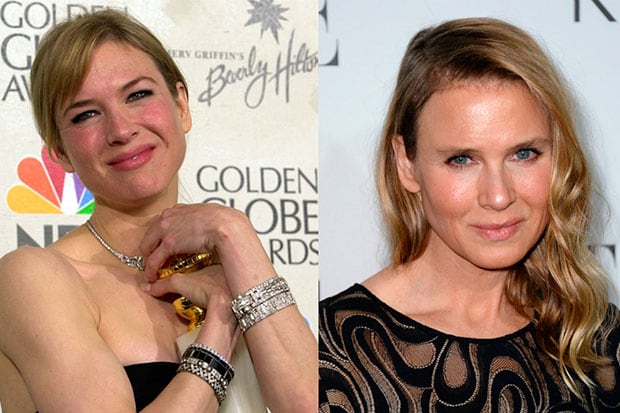 Quand la beauté devient une obsession : ces visages célèbres que la chirurgie a défigurés