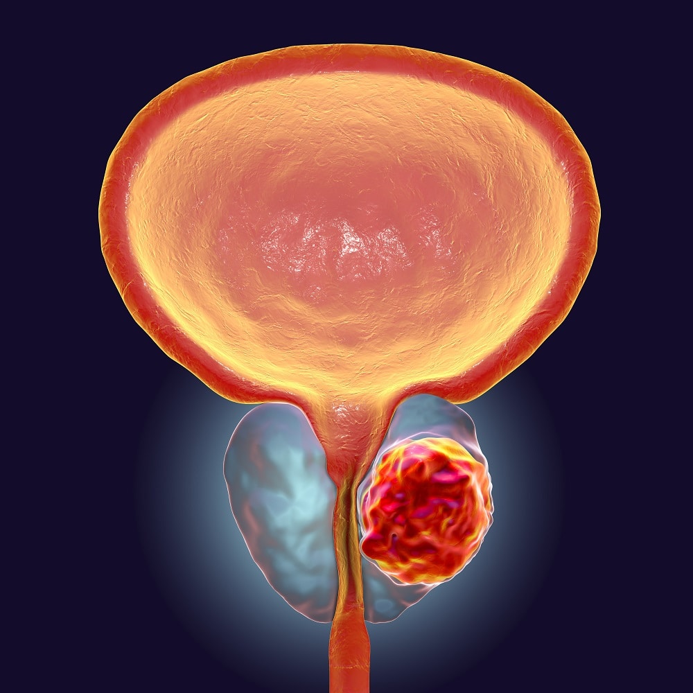 Cancer de la prostate : cette habitude anodine qui pourrait multiplier par deux le risque de mortalité