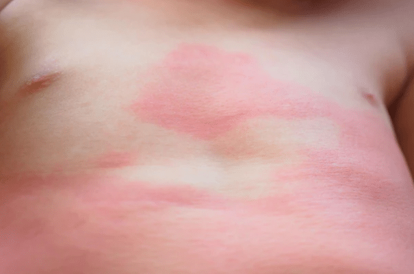 Petits points rouges sur la peau : ce que votre corps essaie vraiment de vous dire