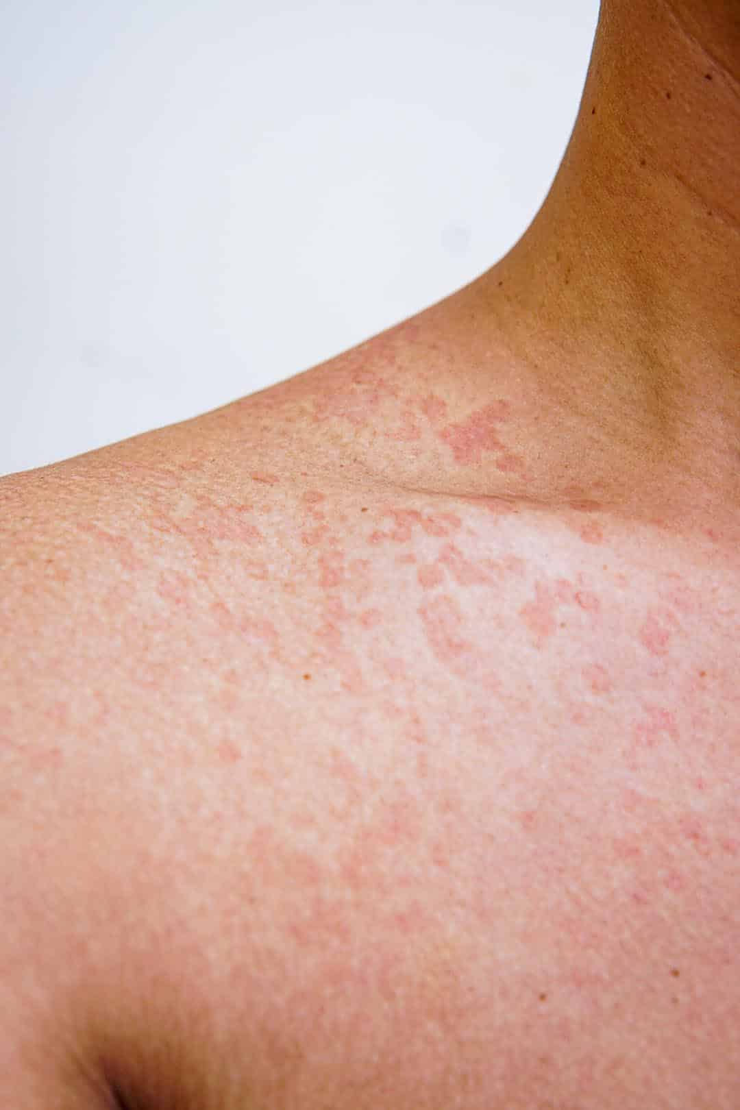 Peau qui parle : ces signes cutanés qui peuvent révéler des problèmes de santé sérieux