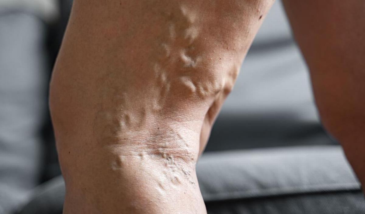 Veines apparentes : ce que votre corps essaie peut-être de vous dire