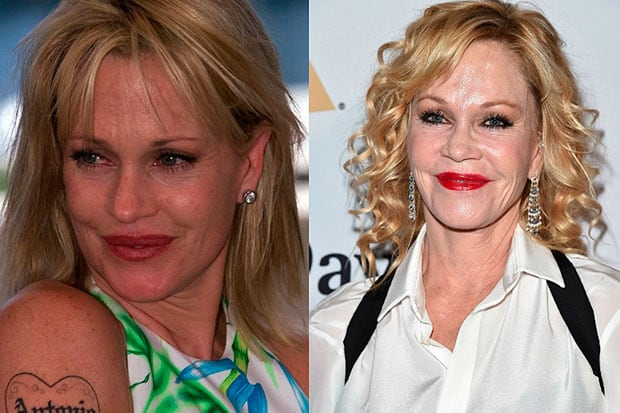 Quand la beauté devient une obsession : ces visages célèbres que la chirurgie a défigurés