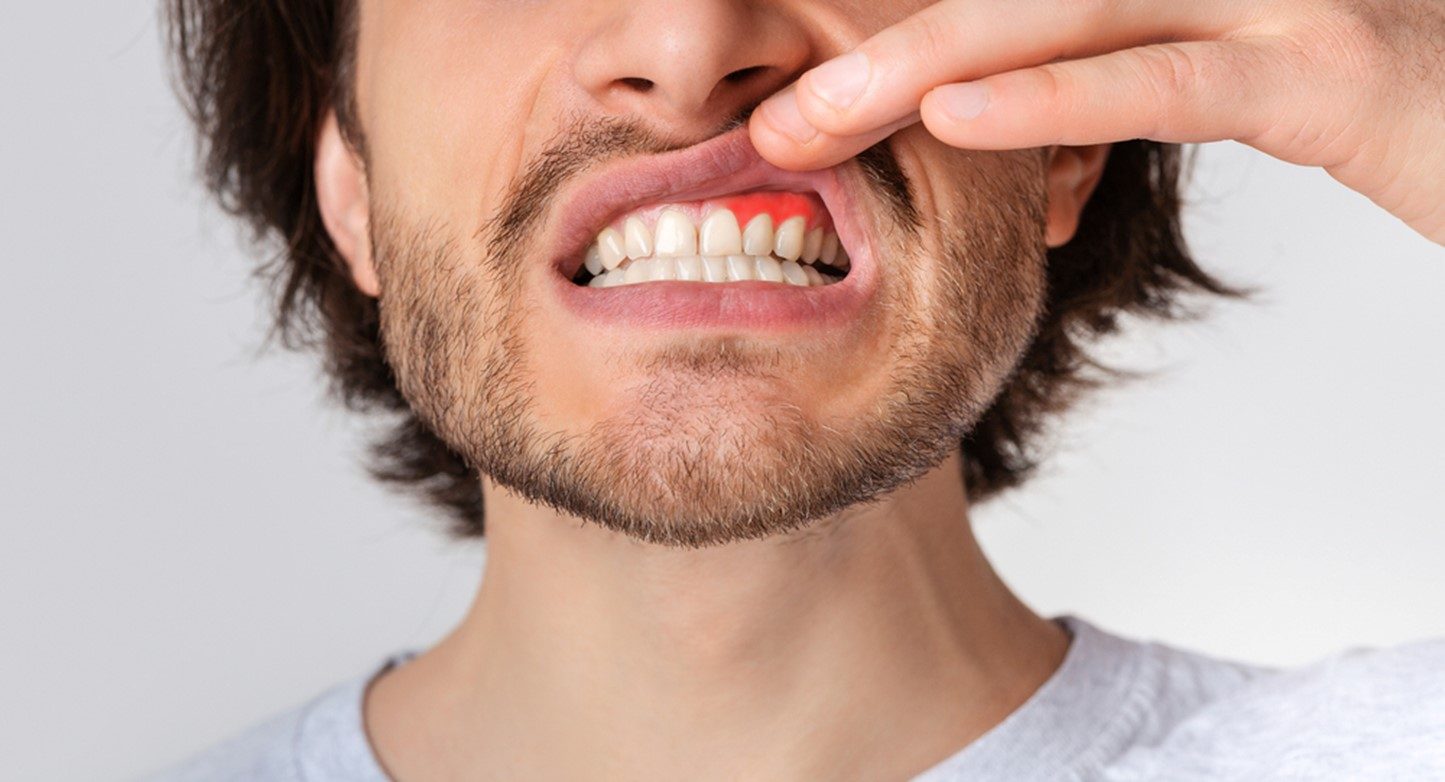 Bouche avec inflammation gingivale visible