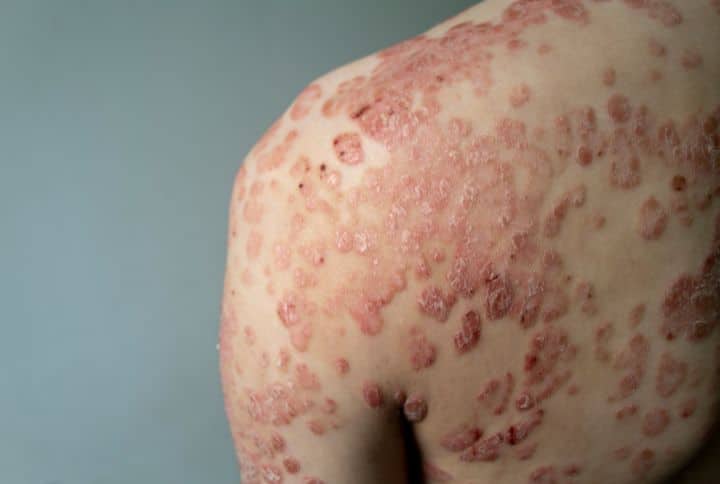Peau qui parle : ces signes cutanés qui peuvent révéler des problèmes de santé sérieux