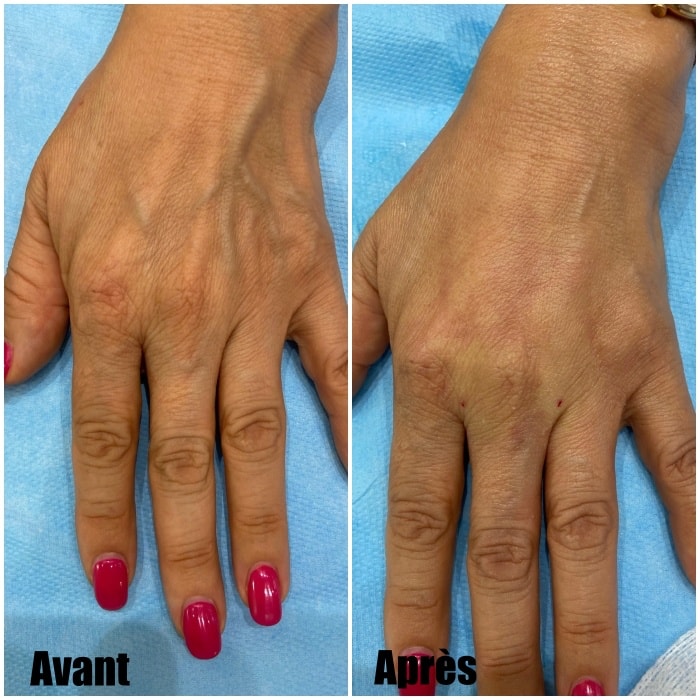 Veines apparentes sur les bras ou les jambes : ce que votre corps veut vraiment vous dire