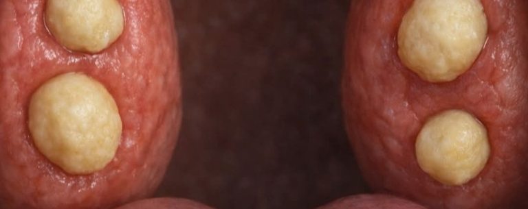 Ces mystérieuses billes blanches qui surgissent dans la gorge : que sont-elles vraiment ?