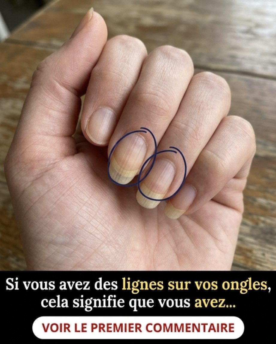 Si vous avez des stries sur vos ongles, en voici la signification
