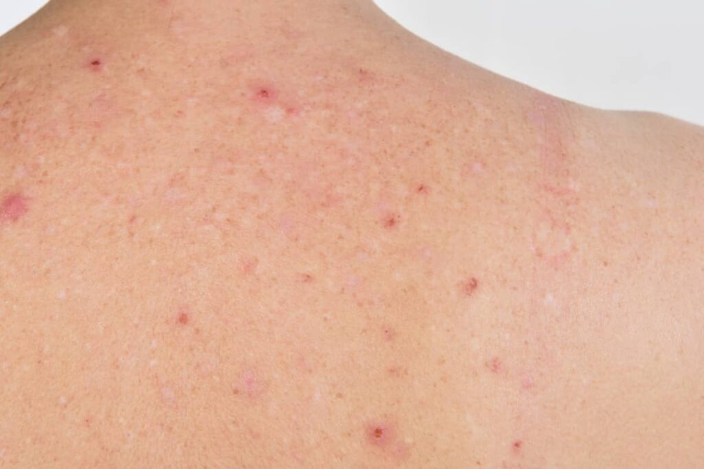 Ces petites taches rouges sur votre peau : ce qu’elles révèlent vraiment (et quand s’inquiéter)