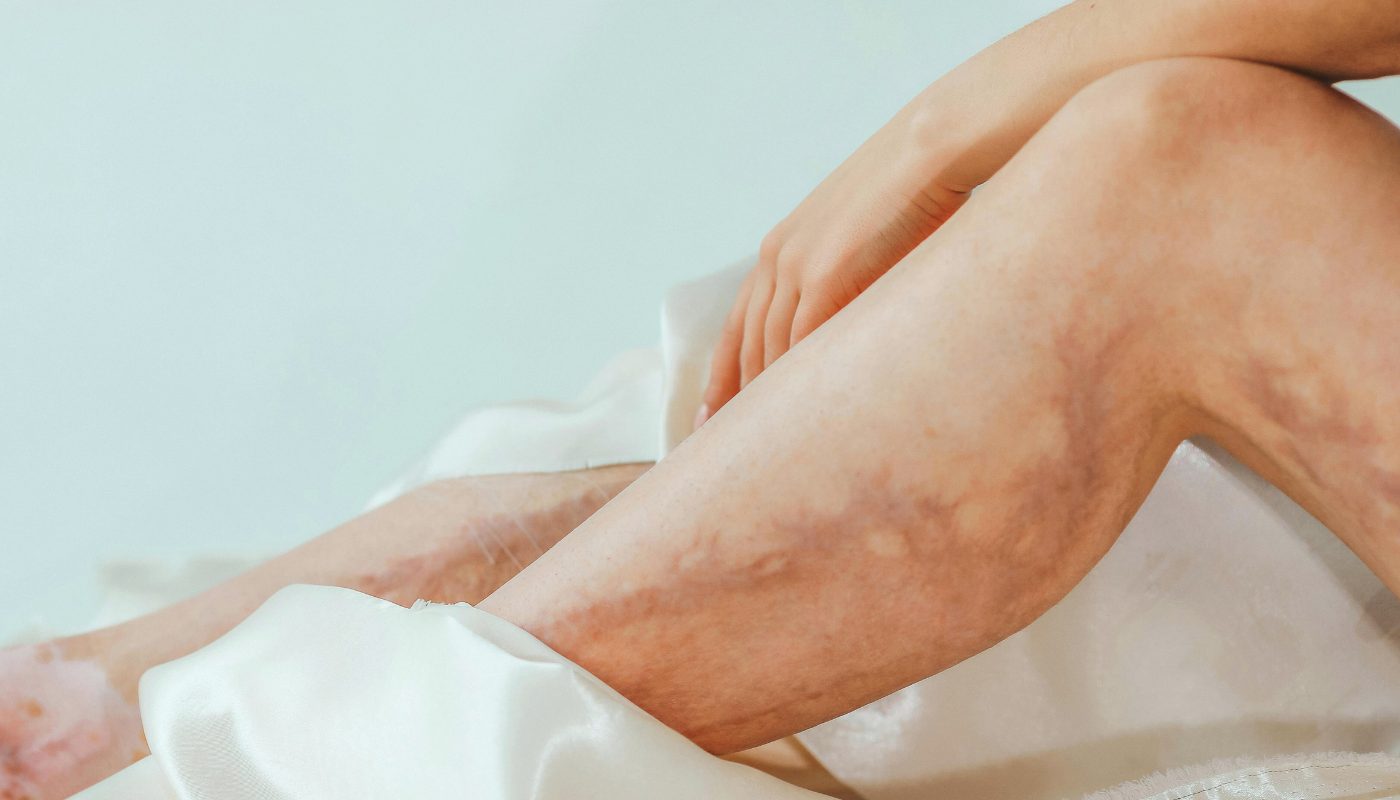 Veines apparentes : ce que votre corps cherche vraiment à vous dire