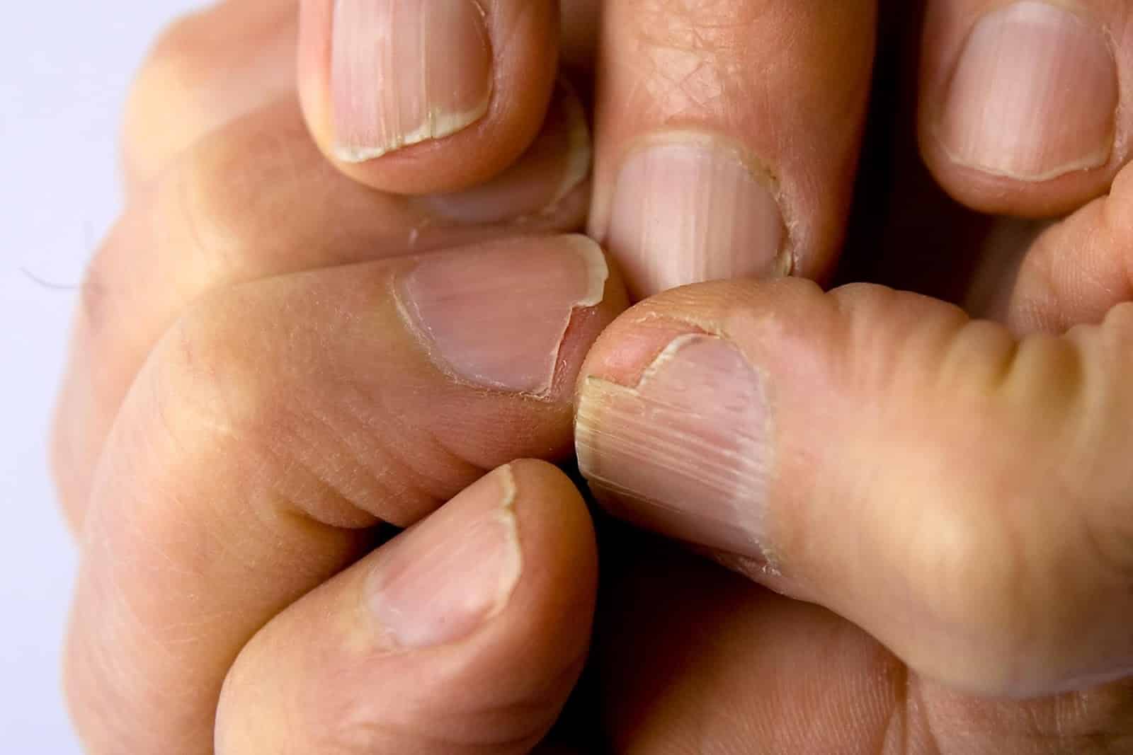 Ongles cassants pouvant révéler une carence nutritionnelle