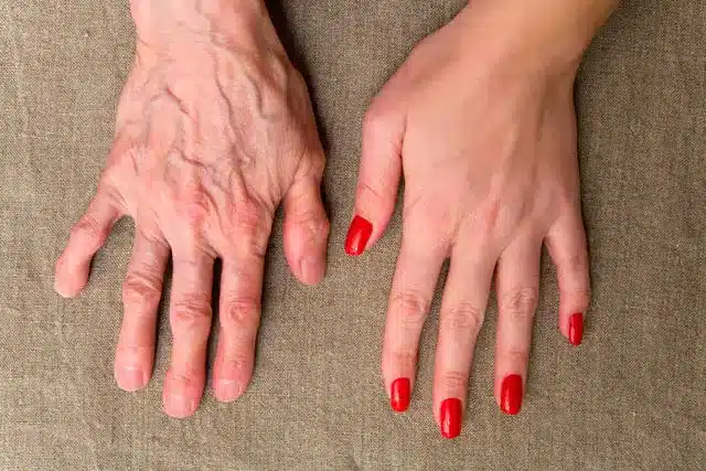 Ces veines apparentes sur vos mains : faut-il vraiment s'en alarmer ?