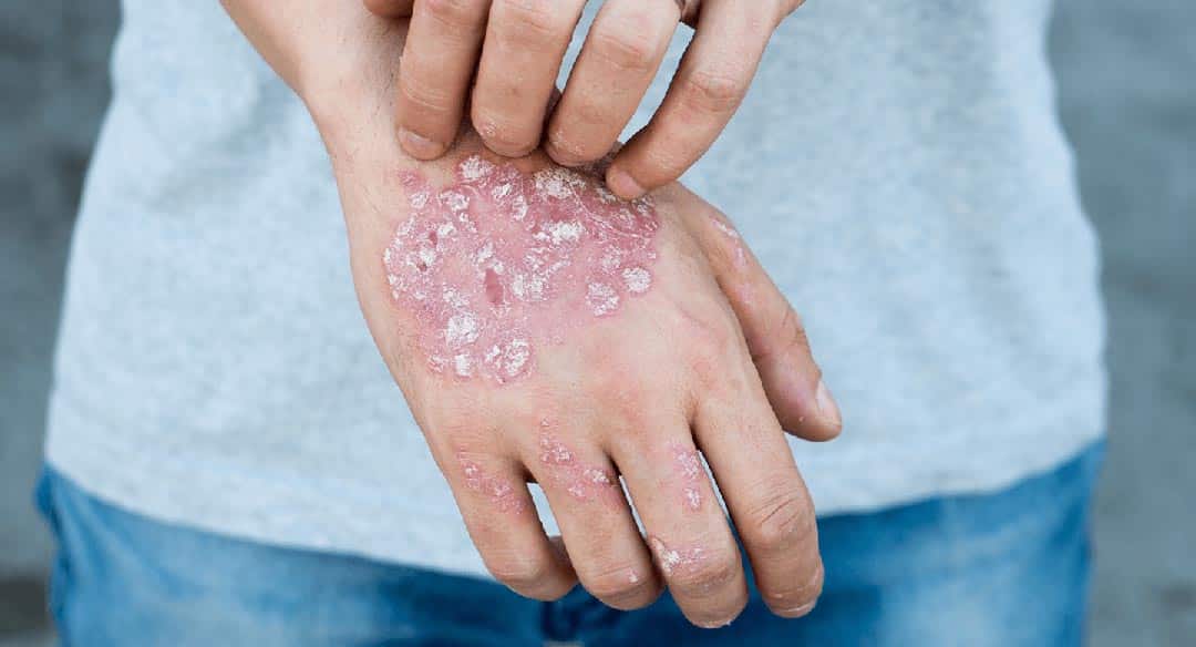 Peau qui parle : ces signes cutanés qui peuvent révéler des problèmes de santé sérieux