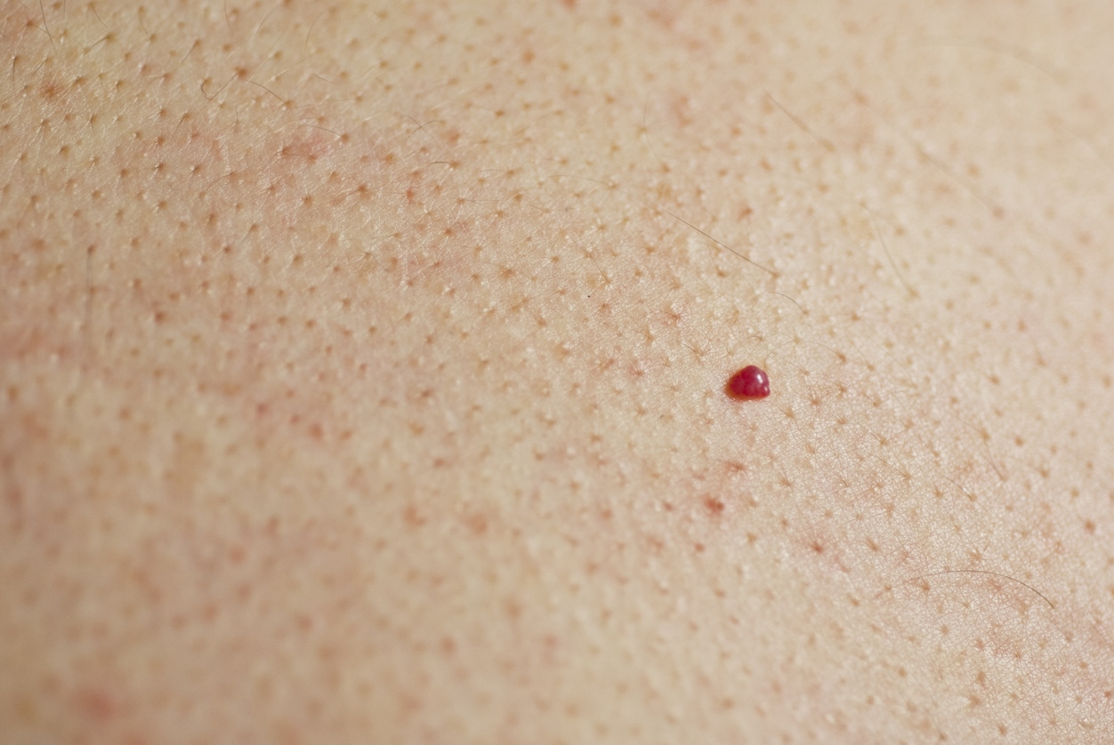Angiome cerise sur la peau