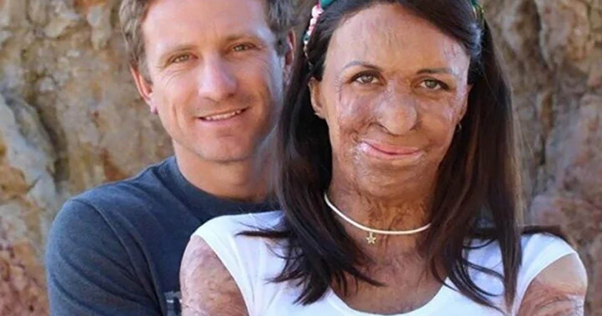 Après que le visage de sa femme a été marqué par un incendie, son mari refuse de l’abandonner