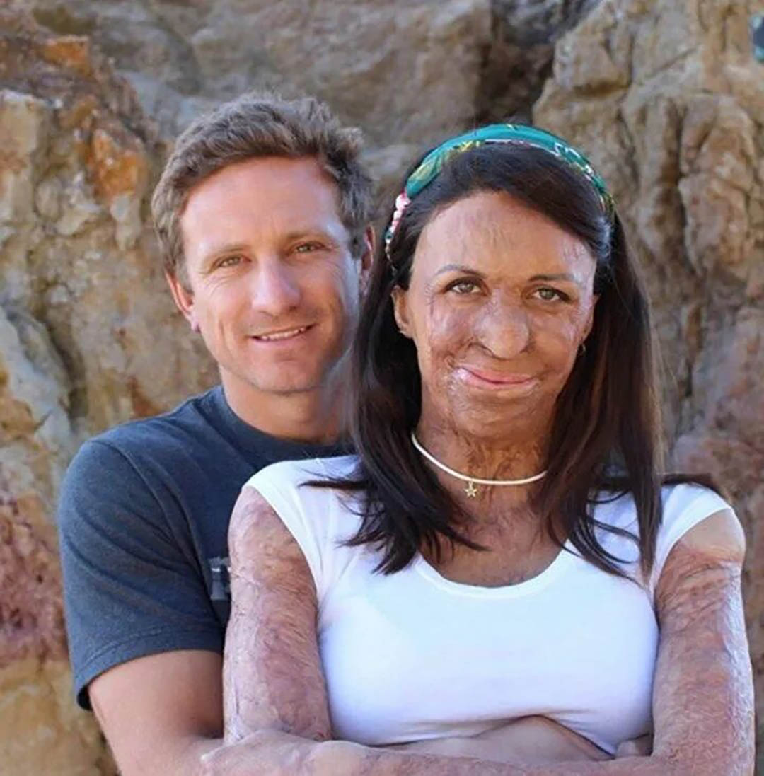 Après que le visage de sa femme a été marqué par un incendie, son mari refuse de l’abandonner