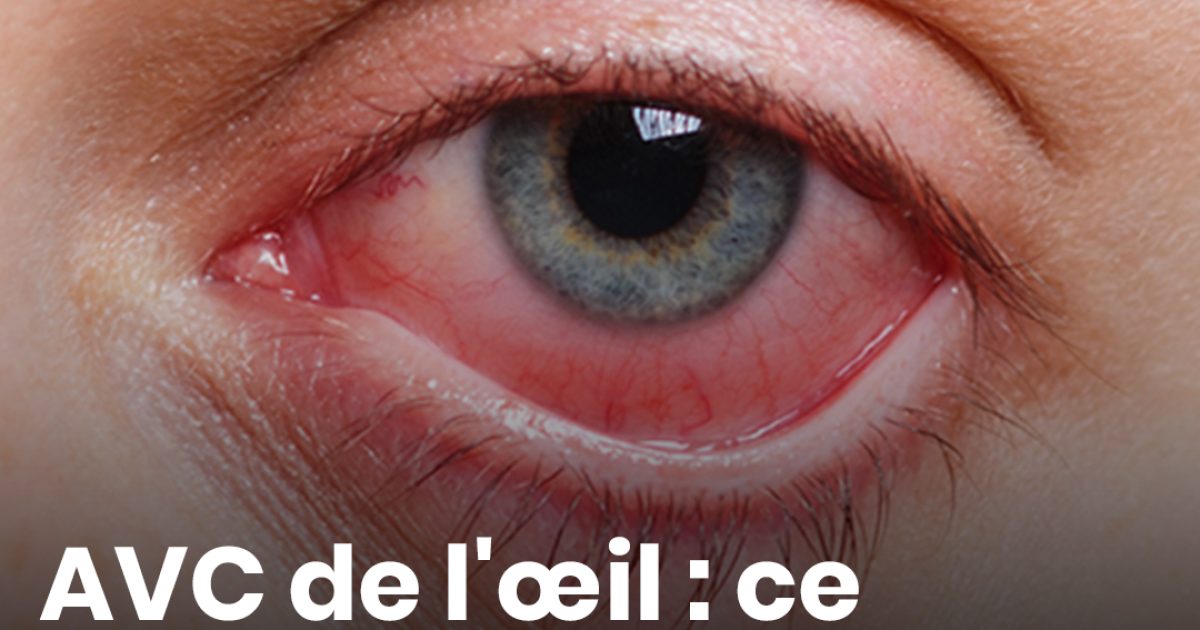 AVC de l'œil : ce symptôme peut vous faire perdre la vue en quelques heures