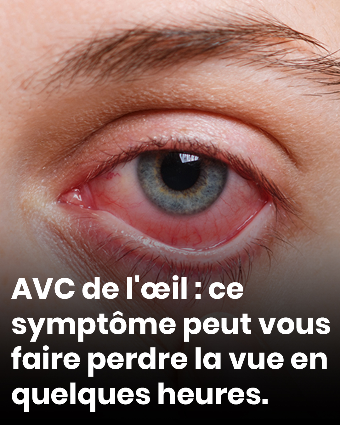 AVC de l'œil : ce symptôme peut vous faire perdre la vue en quelques heures