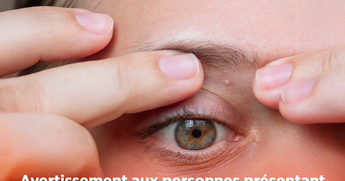 Avertissement aux personnes présentant de petites taches blanches apparaissant sur tout le corps : un médecin explique comment s’en débarrasser