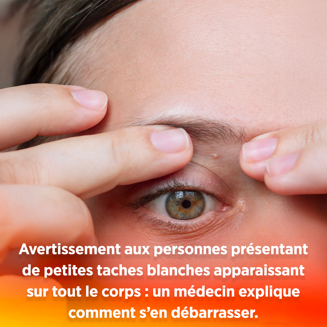 Avertissement aux personnes présentant de petites taches blanches apparaissant sur tout le corps : un médecin explique comment s’en débarrasser