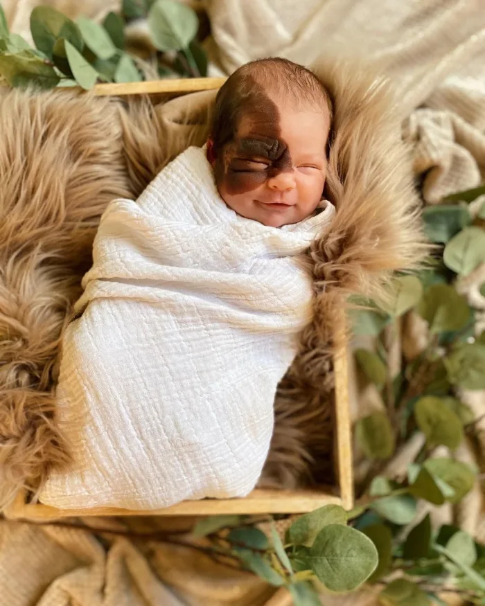 À sa naissance, une tache singulière a stupéfié ses parents : découvrez la petite fille qu’elle est devenue