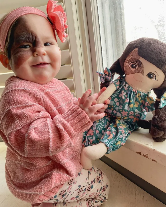 À sa naissance, une tache singulière a stupéfié ses parents : découvrez la petite fille qu’elle est devenue