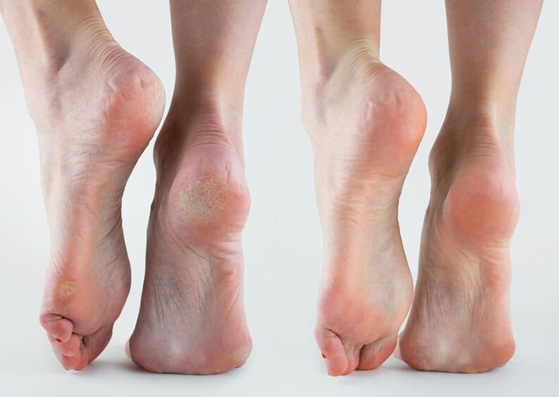 Comparaison avant/après soin des pieds
