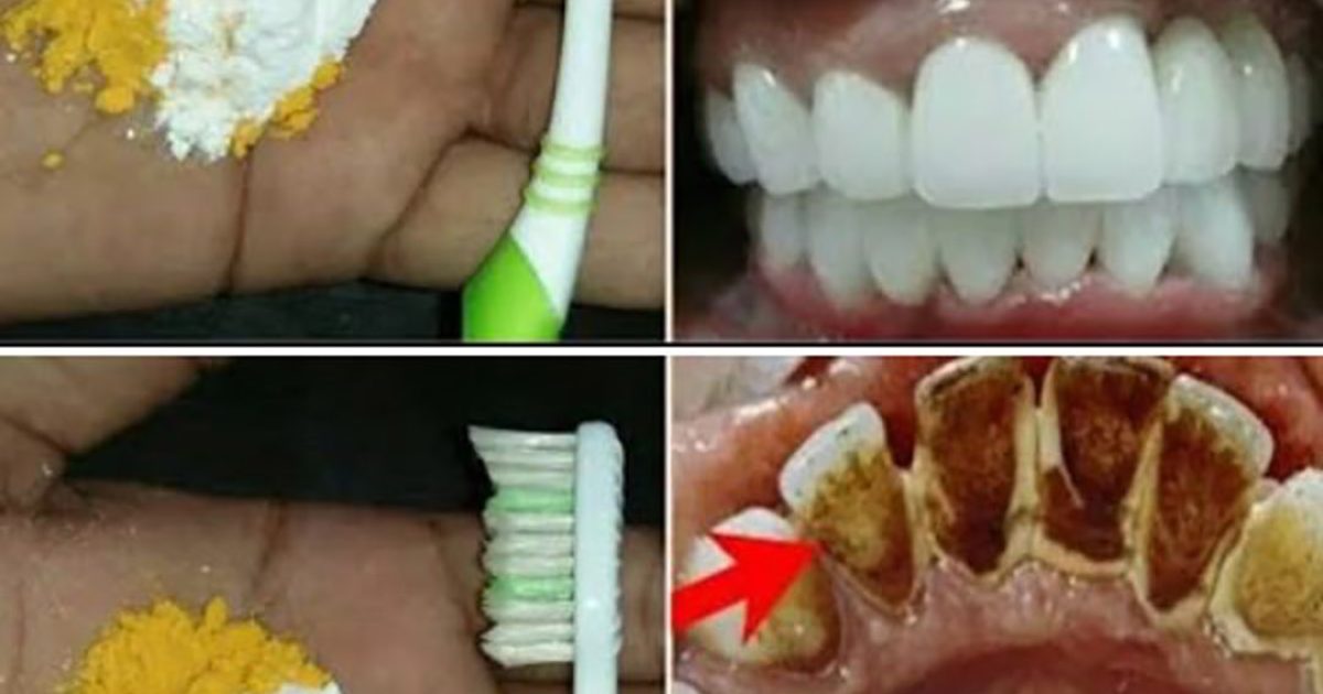 Blanchiment des dents à domicile : obtenez des dents plus blanches en seulement 2 minutes