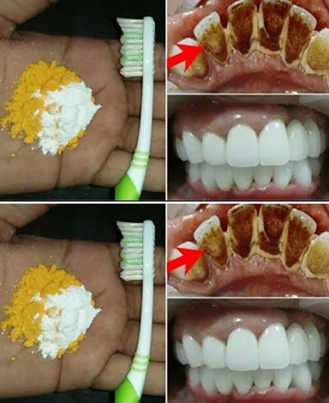 Blanchiment des dents à domicile : obtenez des dents plus blanches en seulement 2 minutes