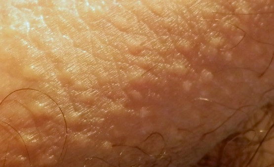 Petits points blancs sur la peau : le vrai visage des glandes de Fordyce