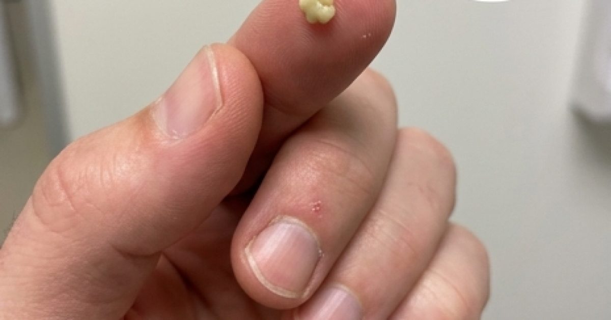 Calculs amygladiens : que sont-ils et comment s’en débarrasser ?