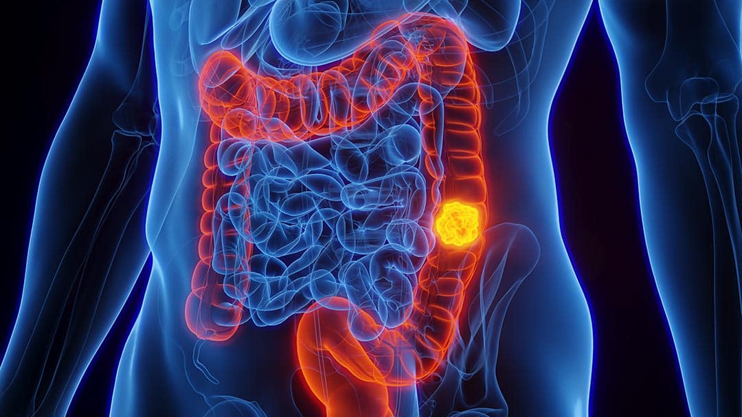Cancer colorectal chez une jeune femme de 20 ans : elle lance un appel après avoir ignoré ces symptômes trop banals