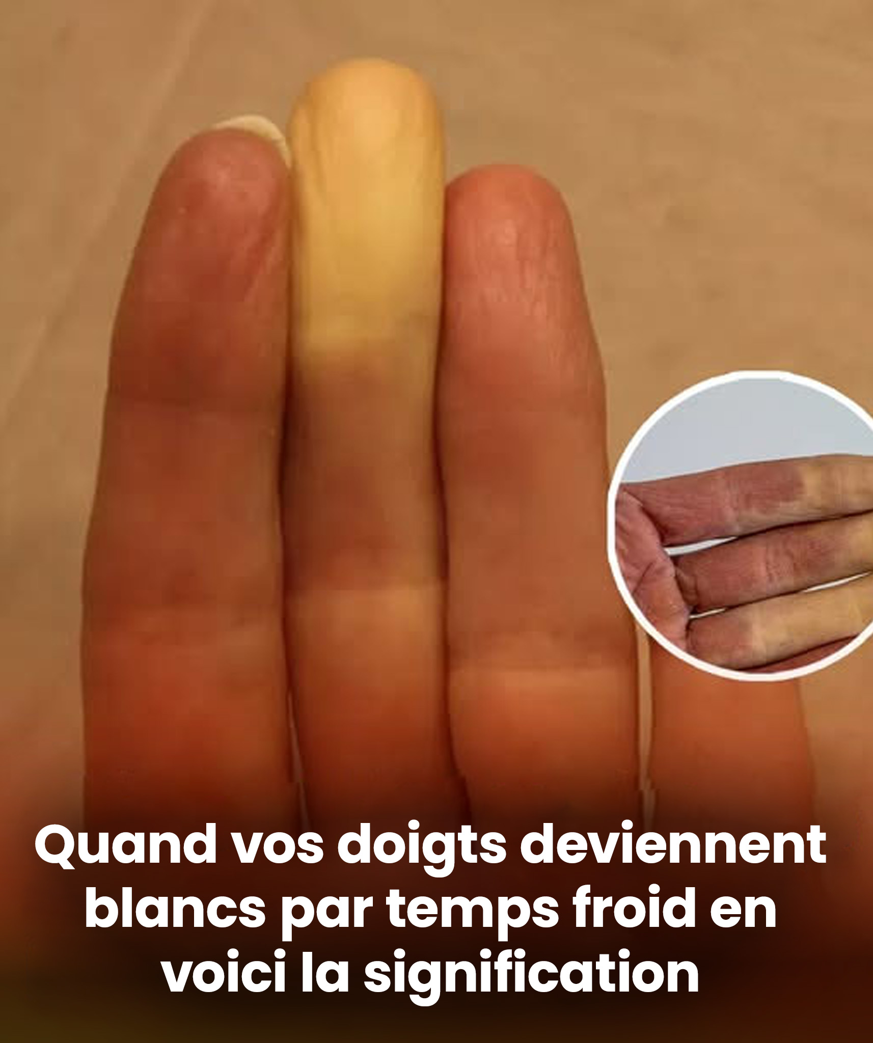 Ce que révèle vraiment le fait qu’un doigt devienne blanc lorsqu’il fait froid