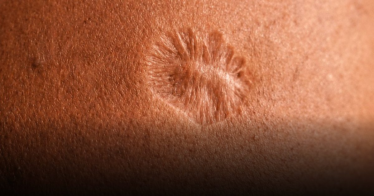 Cicatrice du vaccin contre la variole : pourquoi cela se produit-il ?