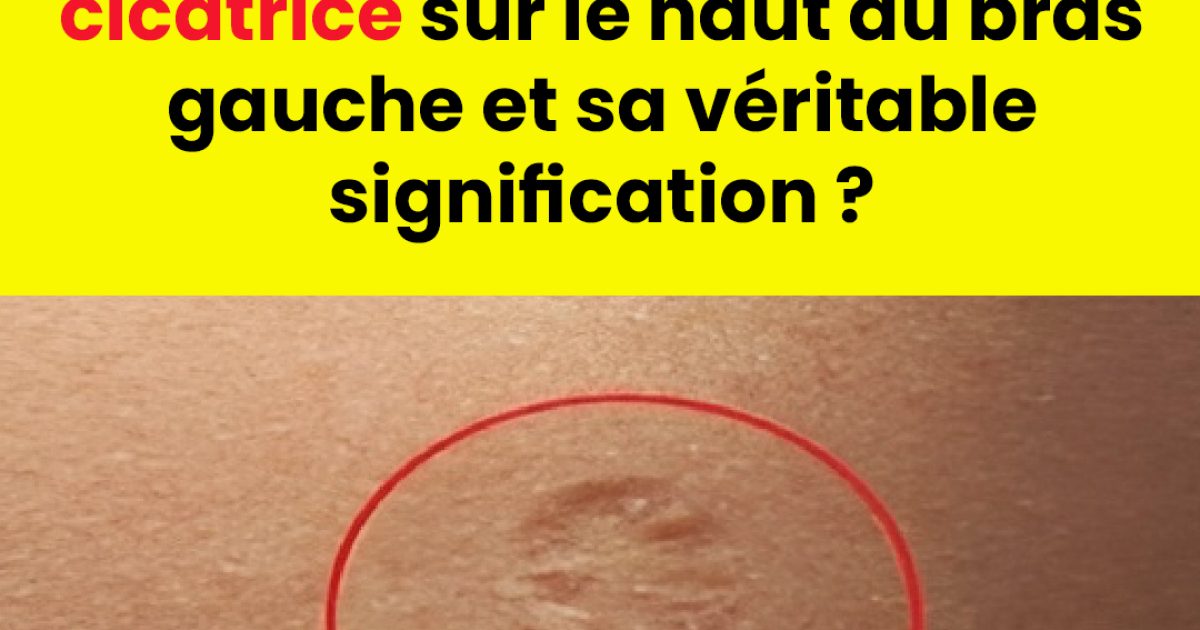 Cicatrices du vaccin contre la variole : à quoi ressemblent-elles et pourquoi apparaissent-elles ?