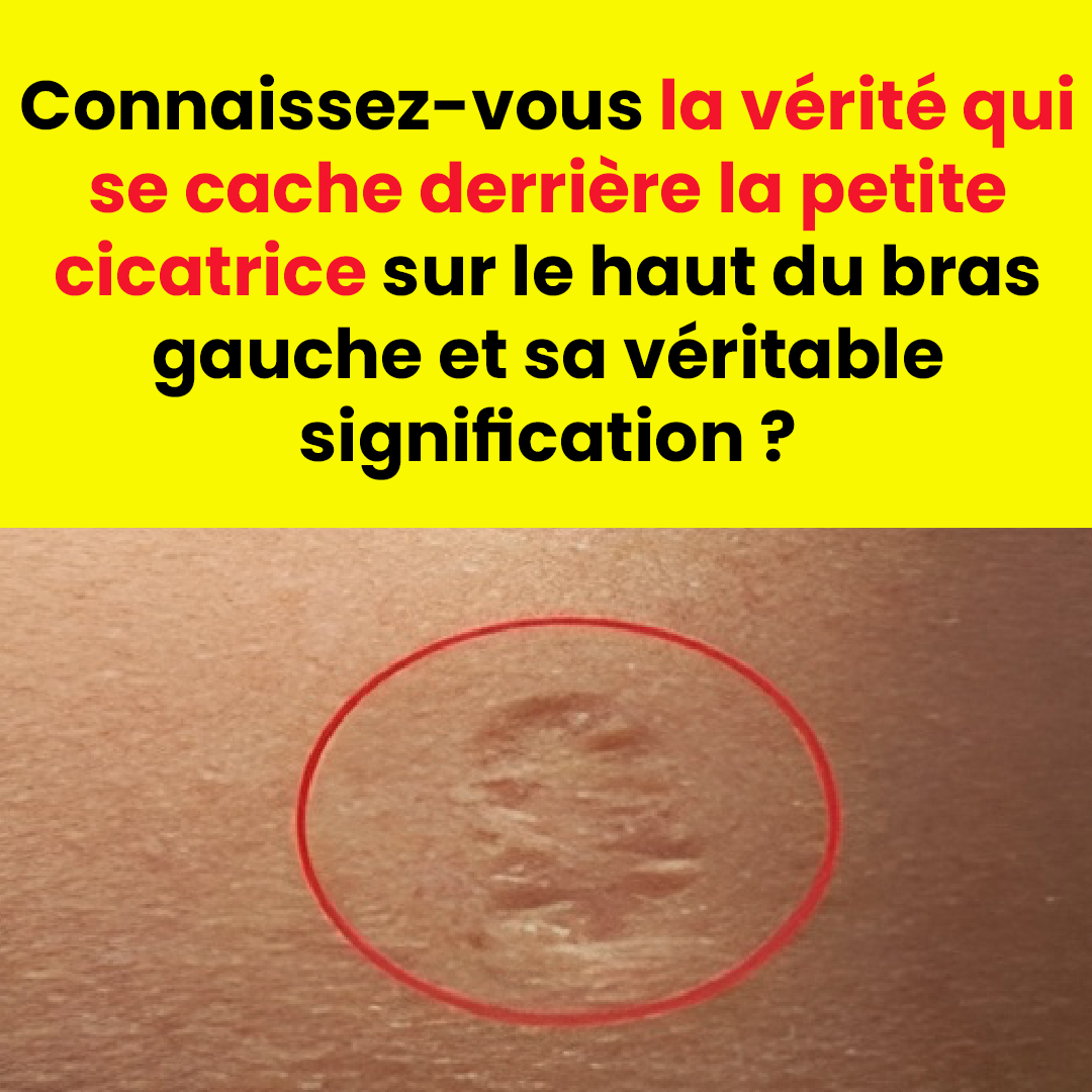 Cicatrices du vaccin contre la variole : à quoi ressemblent-elles et pourquoi apparaissent-elles ?