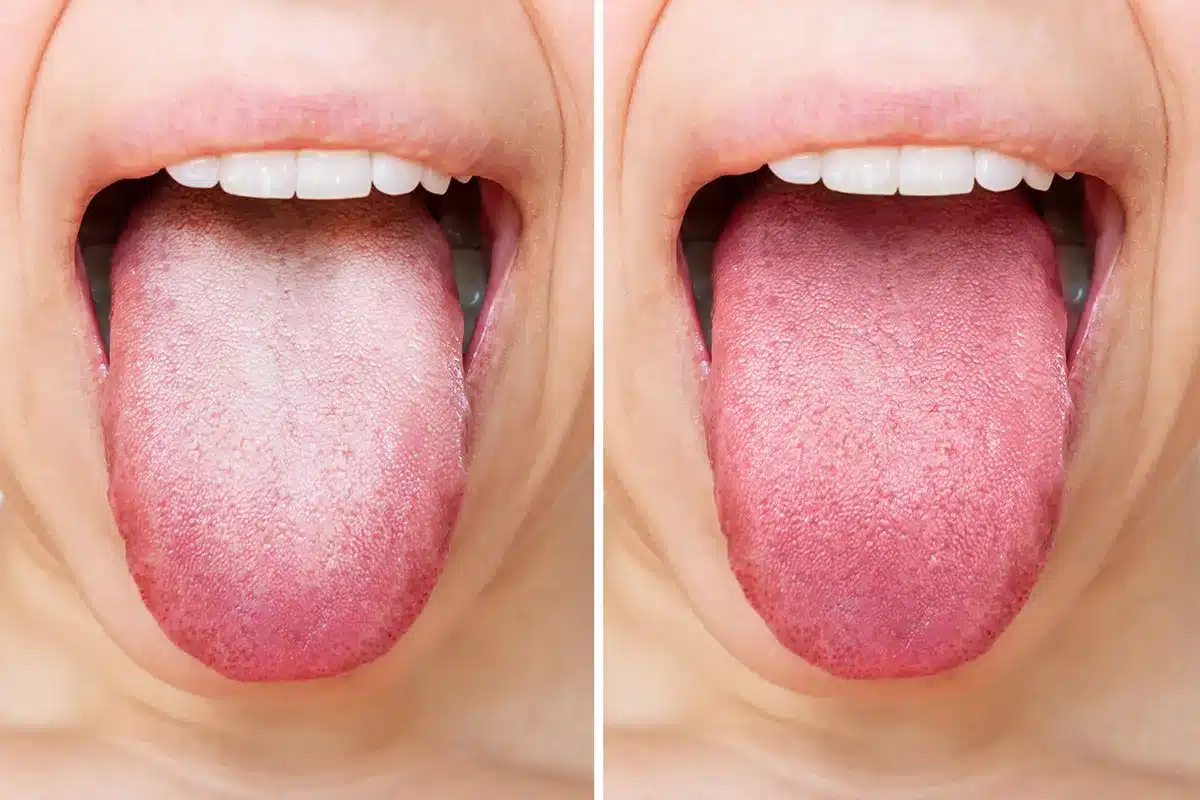 Comparaison de langues saine et pathologique